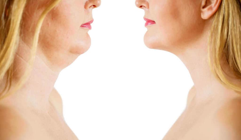 Double Chin treatment Nottinghamshire before and after results