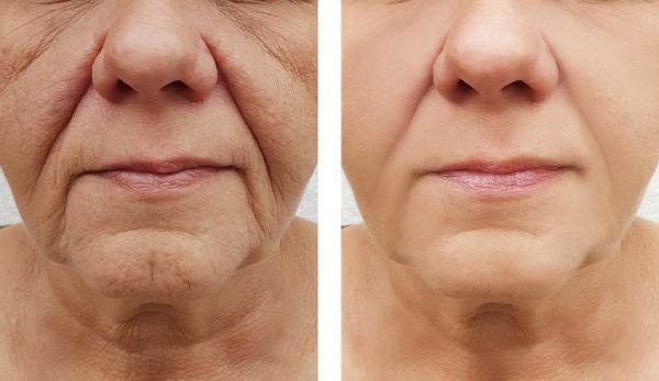 Learn more about Morpheus8 Treatment Nottinghamshire today!