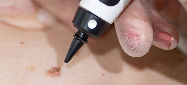 After Skin Tag Removal Nottinghamshire