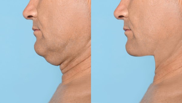 Which Non-Surgical Treatments Work Best for Jowls and Loose Skin Nottinghamshire?