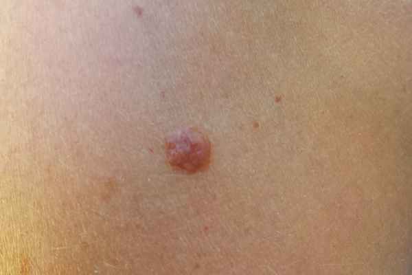 skin tag and freezing