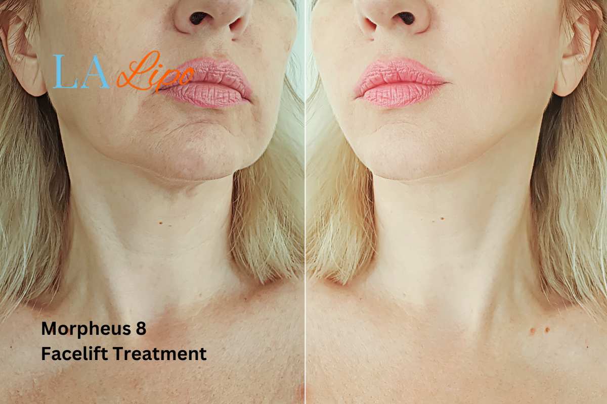 Turn back time with Morpheus8 Treatment Nottinghamshire