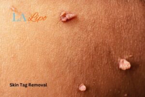 skin tag removal