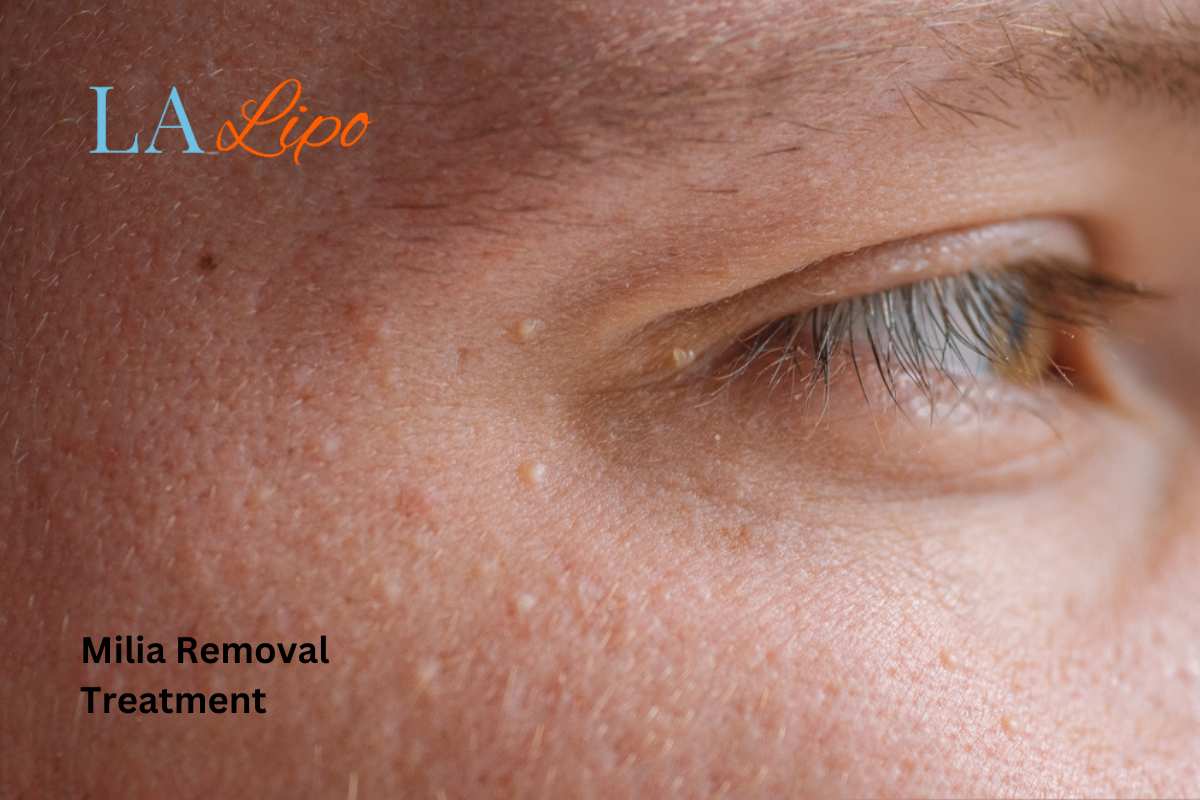 Cryopen Milia Removal: Is It the Easiest and Safest Option Nottinghamshire?