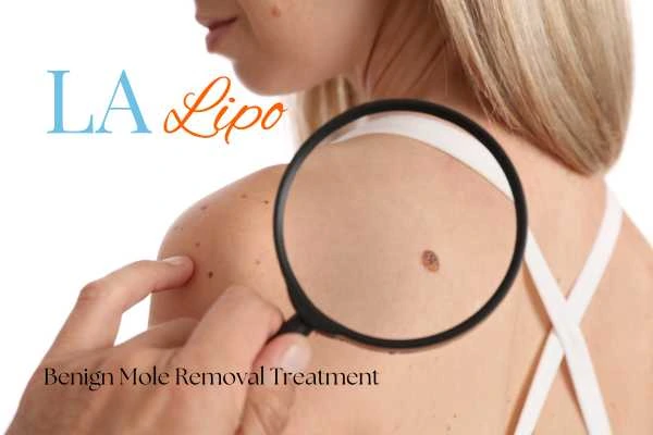 Woman having her inspection of blemish before mole removal Nottinghamshire