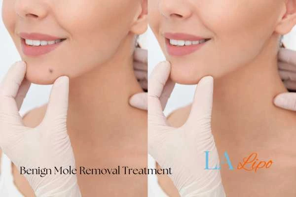 Before and after mole removal Nottinghamshire treatment