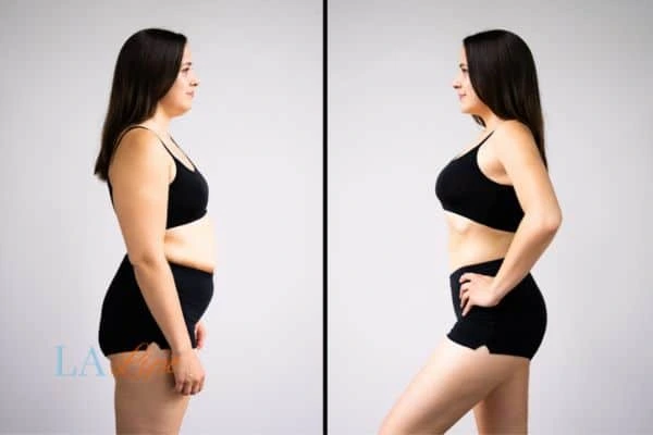 LA-EMS Body Sculpting Nottinghamshire results before and after of womans results on body toning.