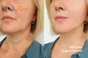 hi-fu for wrinkles Nottinghamshire before and after results