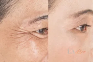 Before and after results of woman - HI-fu wrinkles reduction treatment Nottinghamshire