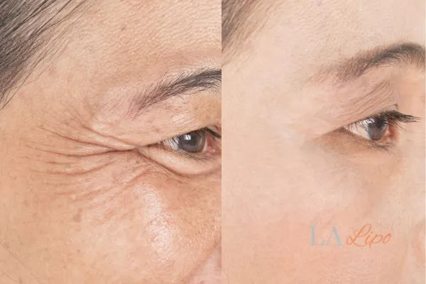 Before and after results of woman - HI-fu wrinkles reduction treatment Nottinghamshire
