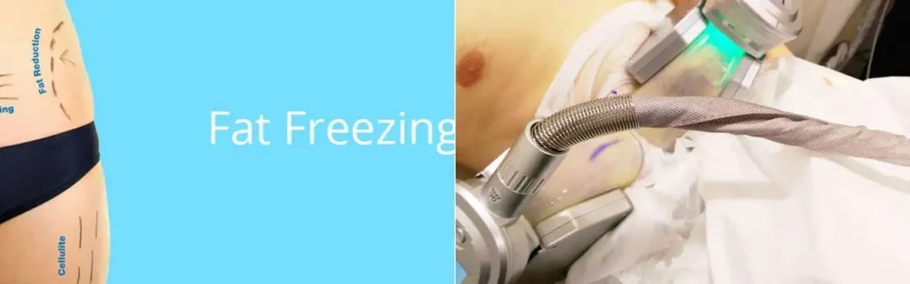 Fat freezing Nottinghamshire on multiple areas of the body