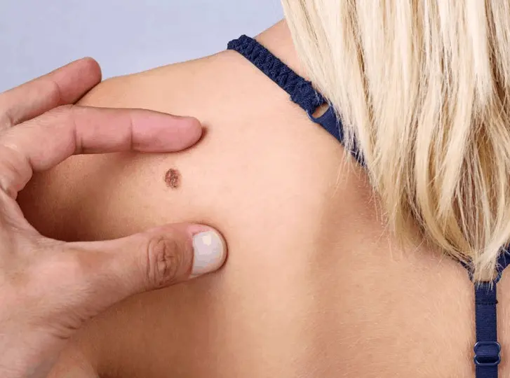 woman having mole removal Nottinghamshire consultation before treatment.