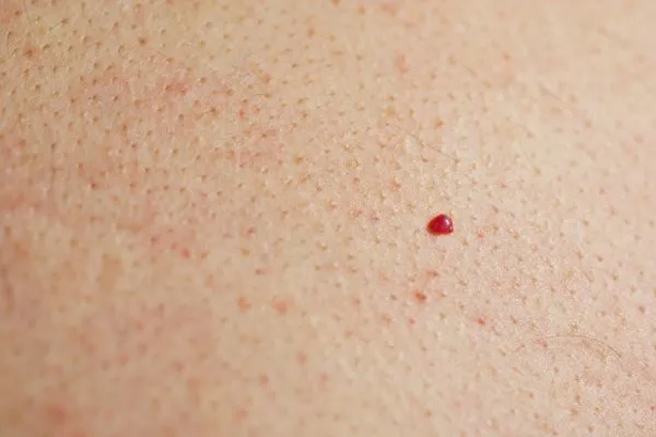 close up of a cherry angioma Nottinghamshire
