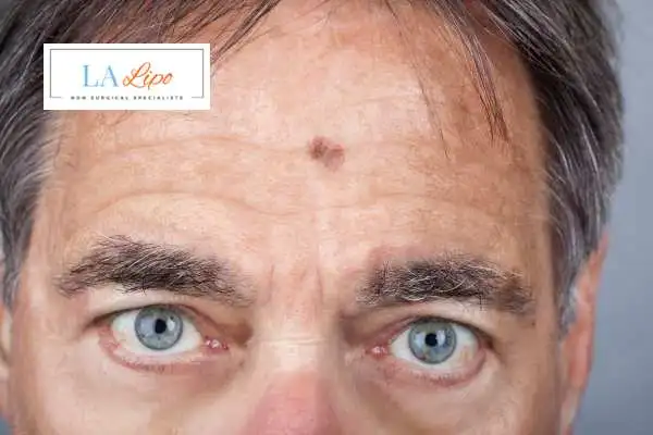 Solar Lentigo Removal Nottinghamshire image of man with mark on his forehead