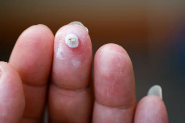 wart on person finger - cryotherapy to treat from LA LIPO Nottinghamshire