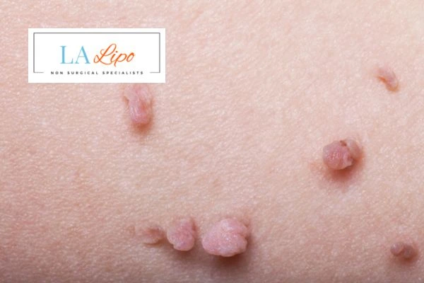 Does cryopen skin tag removal Nottinghamshire hurt? Find out now call our team today!