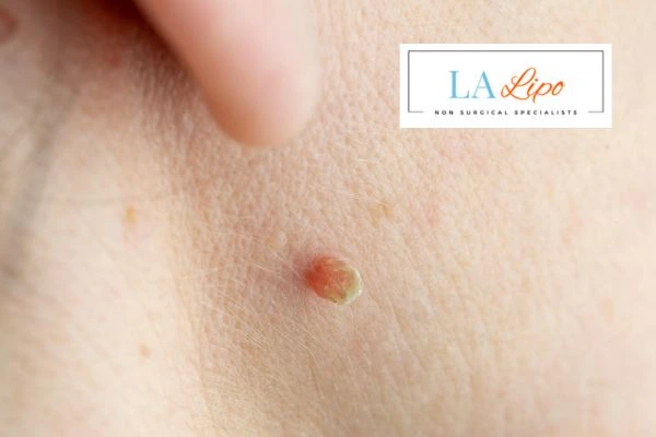 Book skin tag removal Nottinghamshire today speak to our team now!