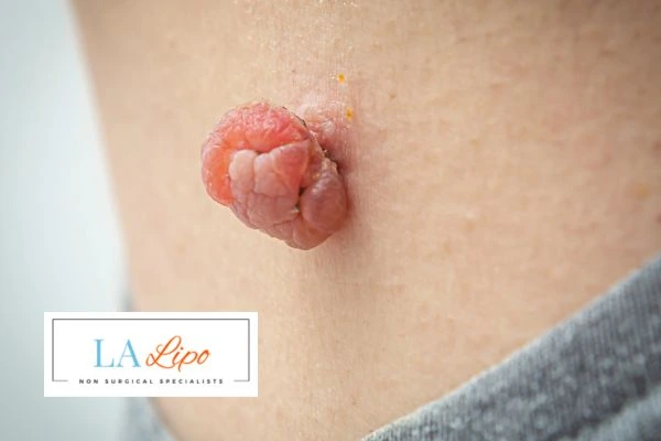 Interested in skin tag removal Nottinghamshire? Concerned about the pain? Find out more today!