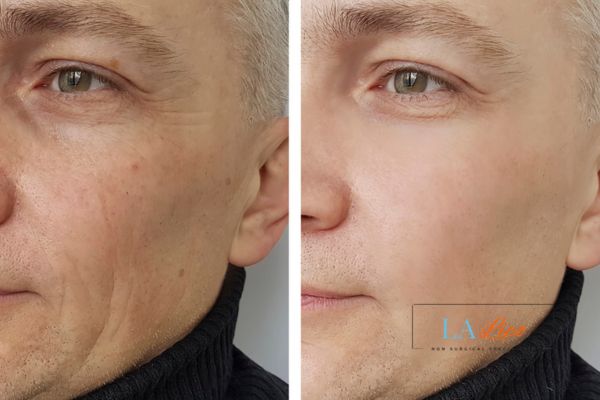 See the amazing results of Morpheus8 Treatment Nottinghamshire!