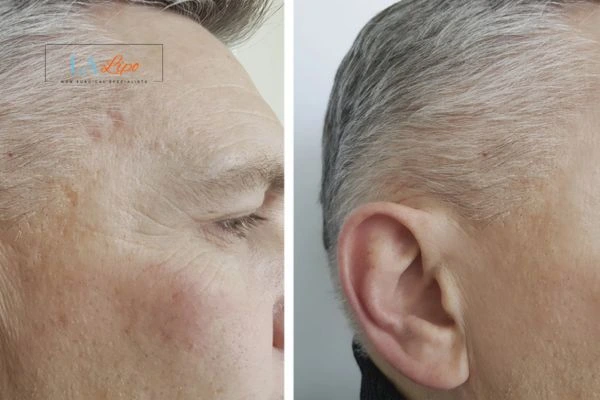 Mens Before & After Morpheus 8 Results Nottinghamshire