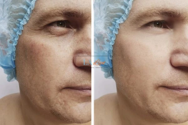 Before and after Morpheus 8 Results Nottinghamshire