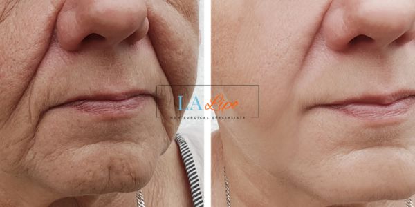 Older lady deeper wrinkle reduction - LA LIPO Morpheus 8 Results Nottinghamshire