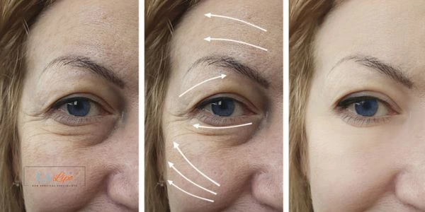 Amazing eye lift Morpheus 8 results Nottinghamshire