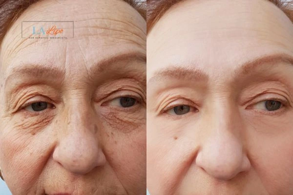 The powerful benefits of Morpheus8 Treatment Nottinghamshire - Call Our team today!