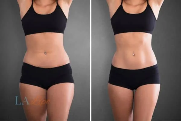before and after results of non-surgical treatment to help a woman's body image and mental health Nottinghamshire