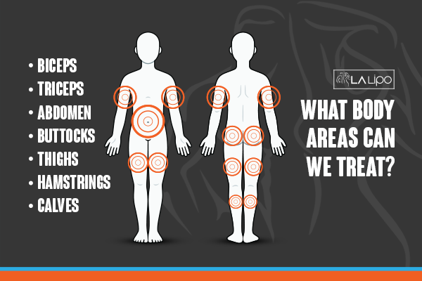 Diagram to show areas you can have LA-EMS Body Sculpting Treatment Nottinghamshire