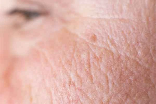 close up picture of a woman's face showing an age spot Nottinghamshire