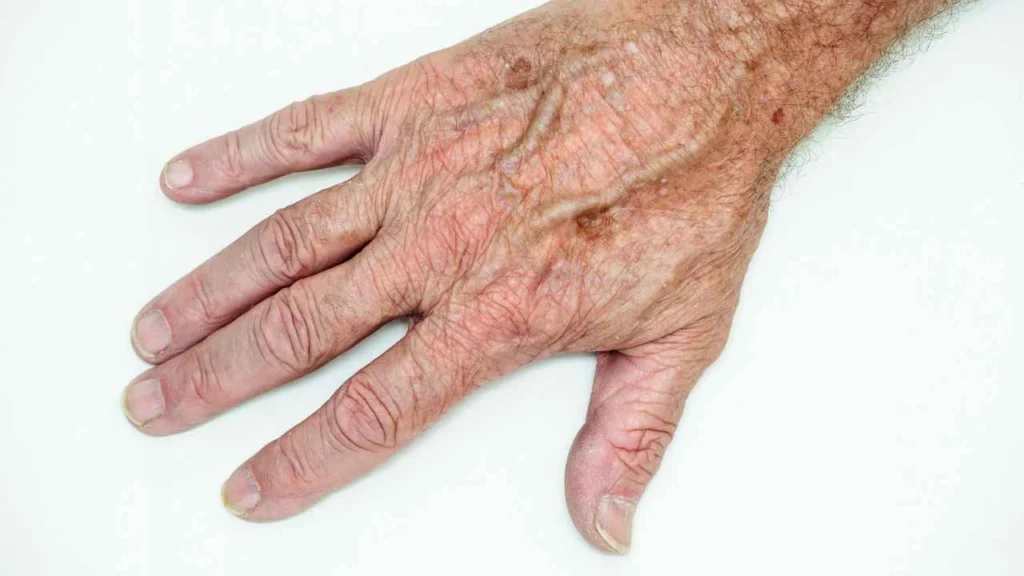 Male hand showing age spot Nottinghamshire