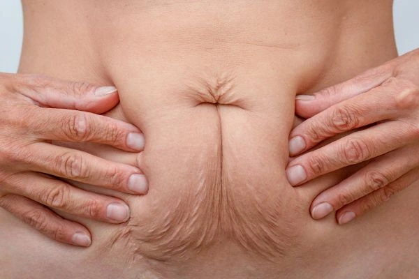 Image of a woman's stomach with loose skin - example of skin tightening Nottinghamshire options