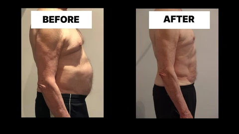 What Symptoms Can Diastasis Recti Cause in Men? Weak Core, Back Pain and Poor Posture Nottinghamshire
